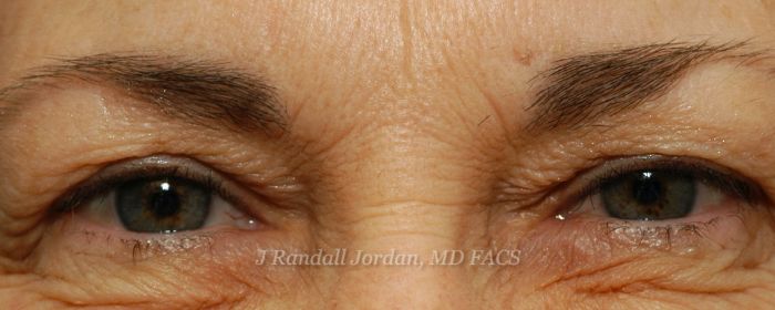 Brow Lift Case 2377 - Faces, PLLC in Ridgeland, MS