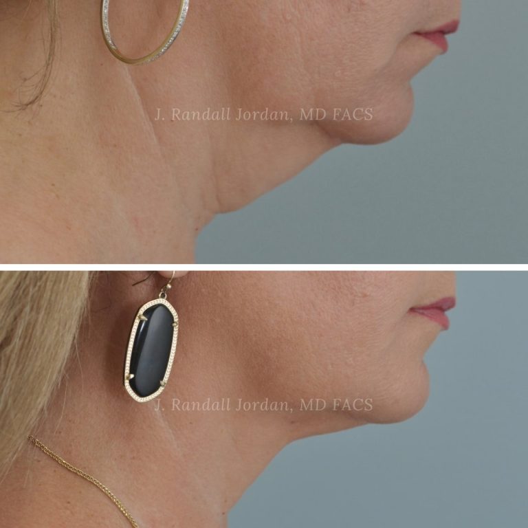 AccuLift RF in Jackson, MS Neck Liposuction + Skin Tightening Faces