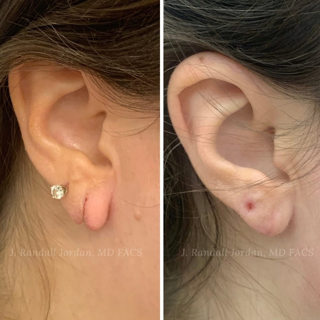 Can Stretched or Torn Earlobes be Repaired? - Dr. Prasad Blog