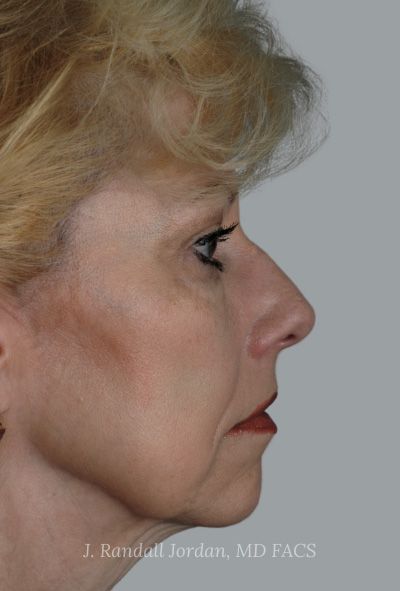 before facelift side view female patient case 3177