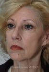 before facelift angle view female patient case 1377