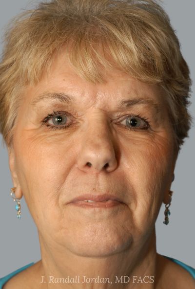 before facelift front view female patient case 1639