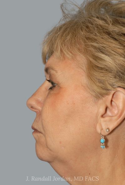 before facelift side view female patient case 1639
