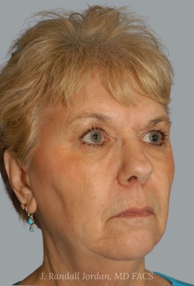 before facelift angle view female patient case 1639