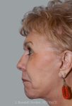 after facelift side view female patient case 1639