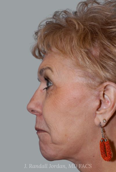 after facelift side view female patient case 1639